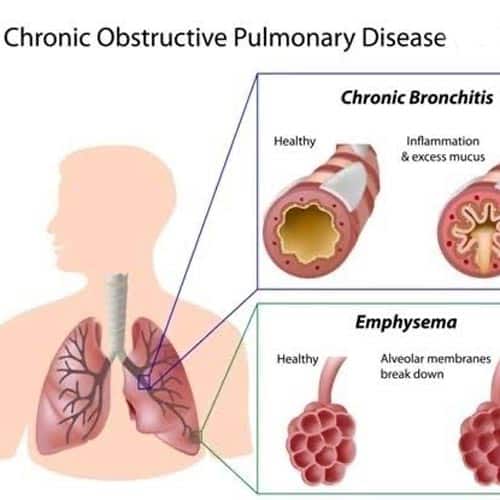 COPD500x
