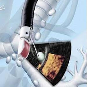 Endo-Bronchial-Ultrasound