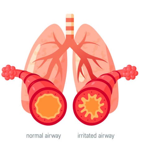 b-asthma2