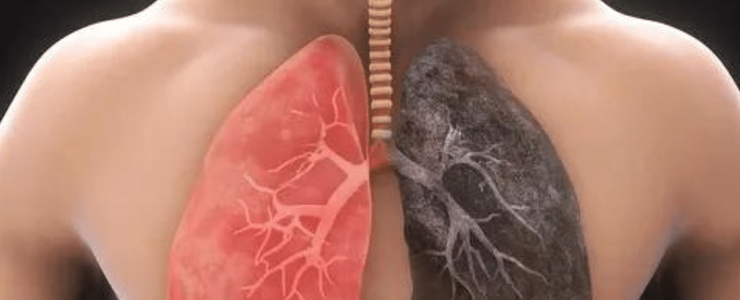 Understanding Chronic Obstructive Pulmonary Disease (COPD): Symptoms, Causes, and Treatment Options
