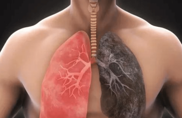 Understanding Chronic Obstructive Pulmonary Disease (COPD): Symptoms, Causes, and Treatment Options