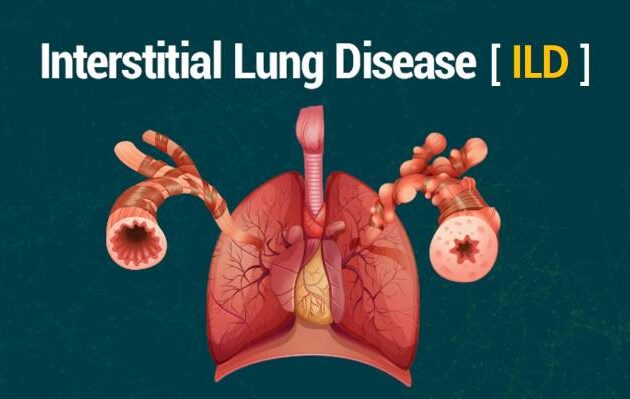 Understanding Interstitial Lung Disease (ILD): A Comprehensive Guide by Dr. Sheetal Chaurasia