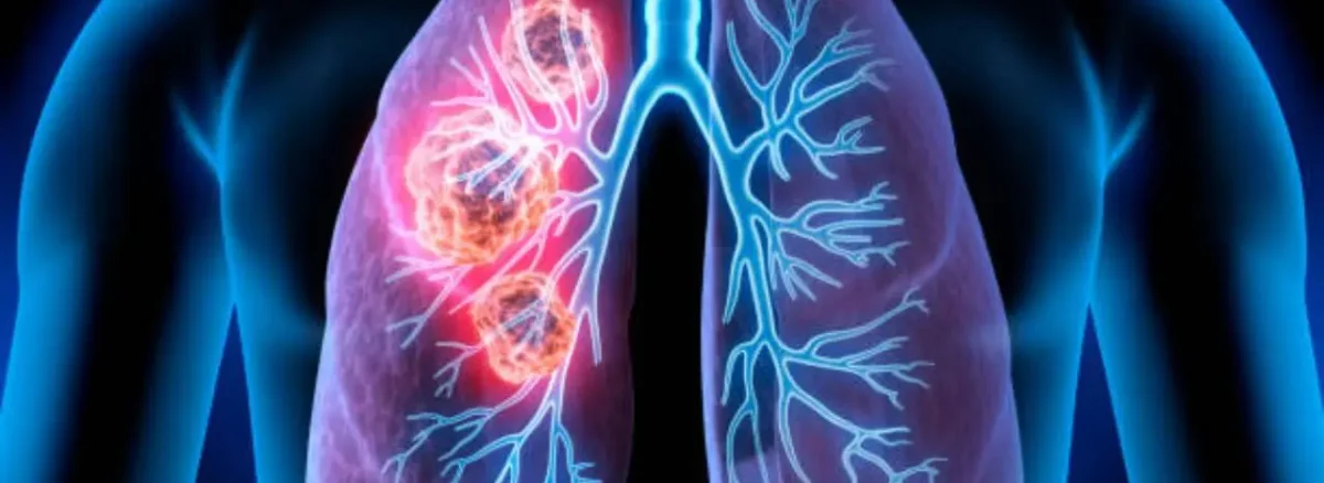 All you need to know about pulmonary fibrosis, the lung condition that caused Zakir Hussain’s death