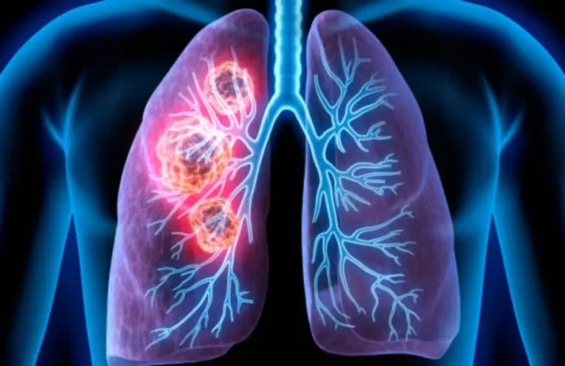 All you need to know about pulmonary fibrosis, the lung condition that caused Zakir Hussain’s death