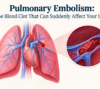 Pulmonary Embolism: The Blood Clot That Can Suddenly Affect Your Lungs